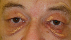 comment traiter xanthelasma